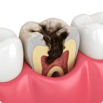 Without treatment, decay spreads deeper toward the nerve.